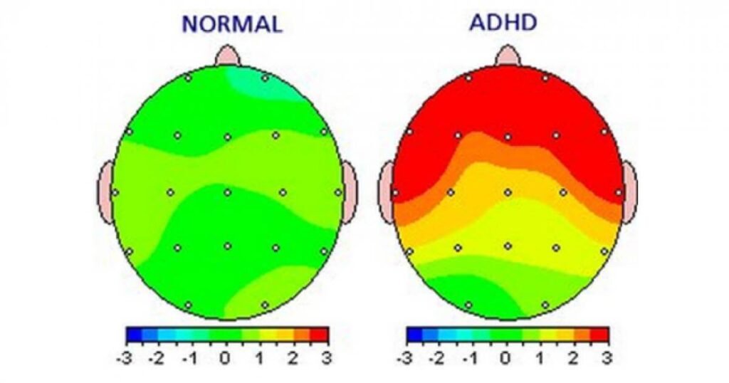 cerveau tdah